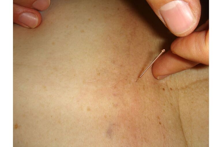 acupuncture-needle-acupuncture-needle-skin
